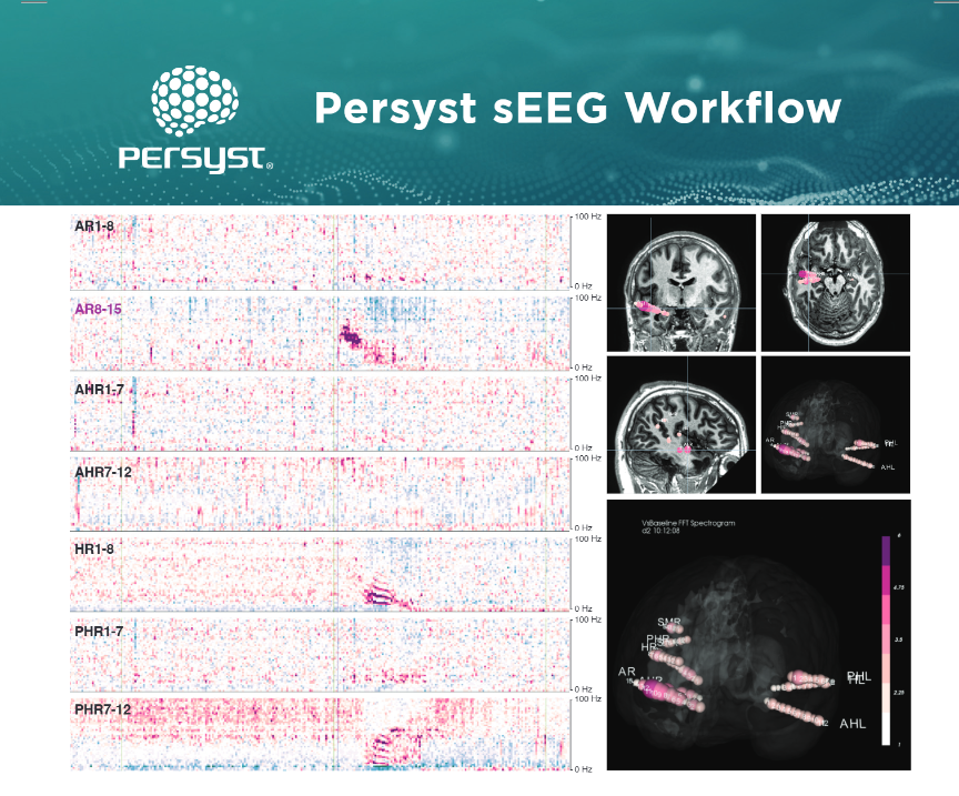 PersystEEG's tweet photo. Stop by the Persyst booth #501 at the ACNS Annual Mtg Feb 19-22 in New Orleans. We have new capabilities for #sEEG visualization and analysis to get your feedback on. https://t.co/sCXh1kBQrR