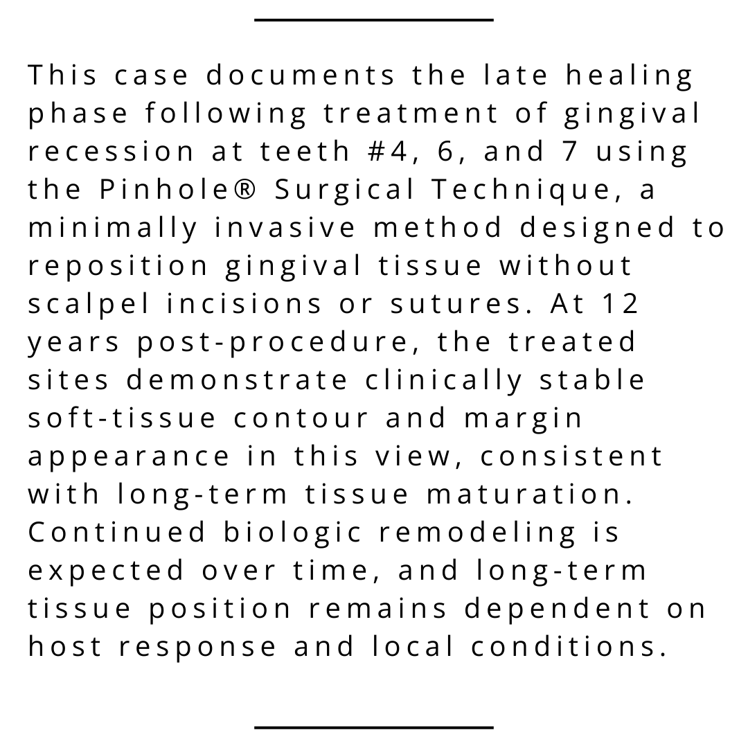 JohnChaodds's tweet photo. Clinical Observation — Gingival Recession
Pinhole® Surgical Technique | Teeth #4, 6, 7
Procedure year: 2013 | Follow-up: 12 years (observed 2026)
Late-phase follow-up demonstrating stable soft-tissue contour in this view.
#PinholeSurgicalTechnique #GingivalRecession https://t.co/75tU8vsV6b