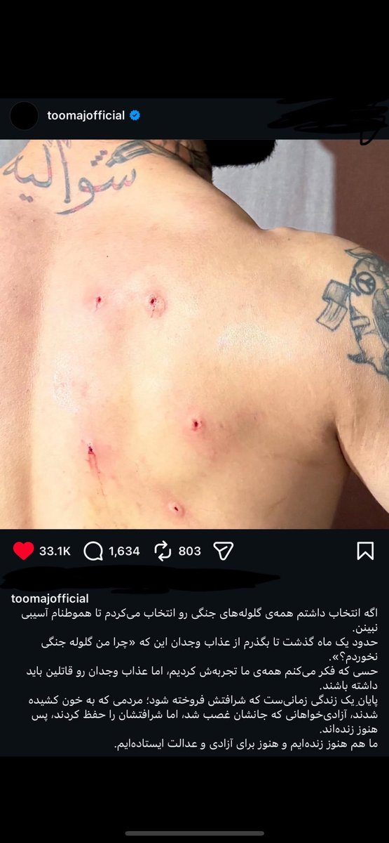 AgeofPahlavi's tweet photo. سلام به عنوان یک فرد کادر پزشکی :
تصویری که میبنید 
جای ساچمه نیست
آسیب ساچمه ضربه ای و باعث پاره شدن مویرگ و ایجاد کبودی میشه
چیزی که در تصویر میبیند تزریق داخل جلدی ID 
احتمالا یک محلول انفوزیون داخل جلدی زدن بهش مثل نرمال سالین بعد با نیدل سوراخ کردن نوک بر آمدگی تا خون بیاد https://t.co/q6CPzXGpNk