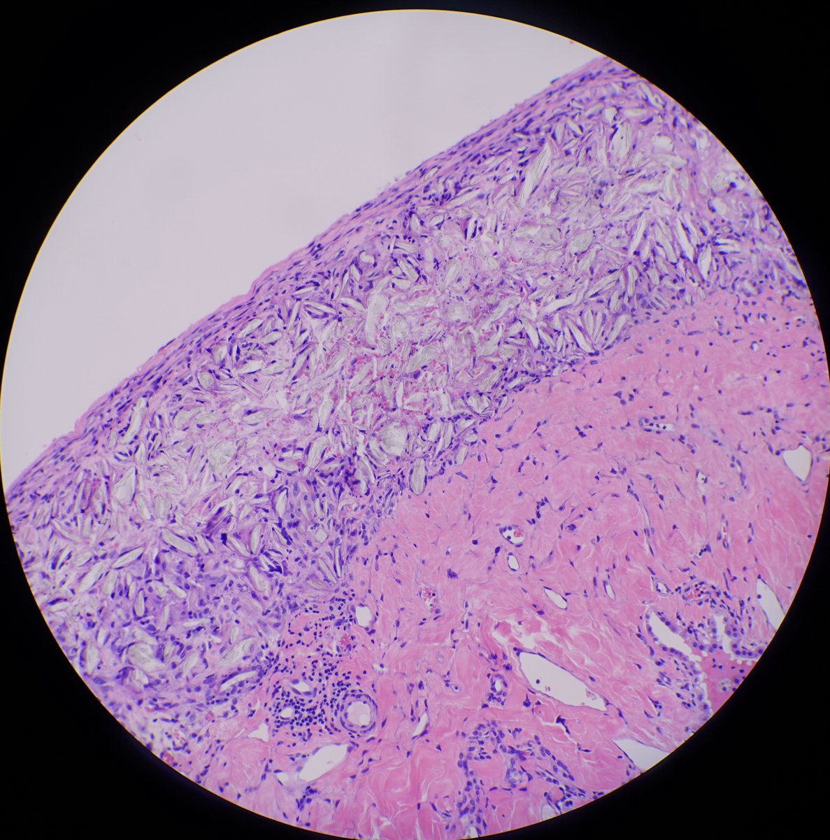 RFutoran's tweet photo. Wedge biopsy of RUL.  What is wrong with the pleural surface?  
#pulmpath #pathology #pathX 

https://t.co/LVQVJw1z5o https://t.co/7mFNgZzaHu