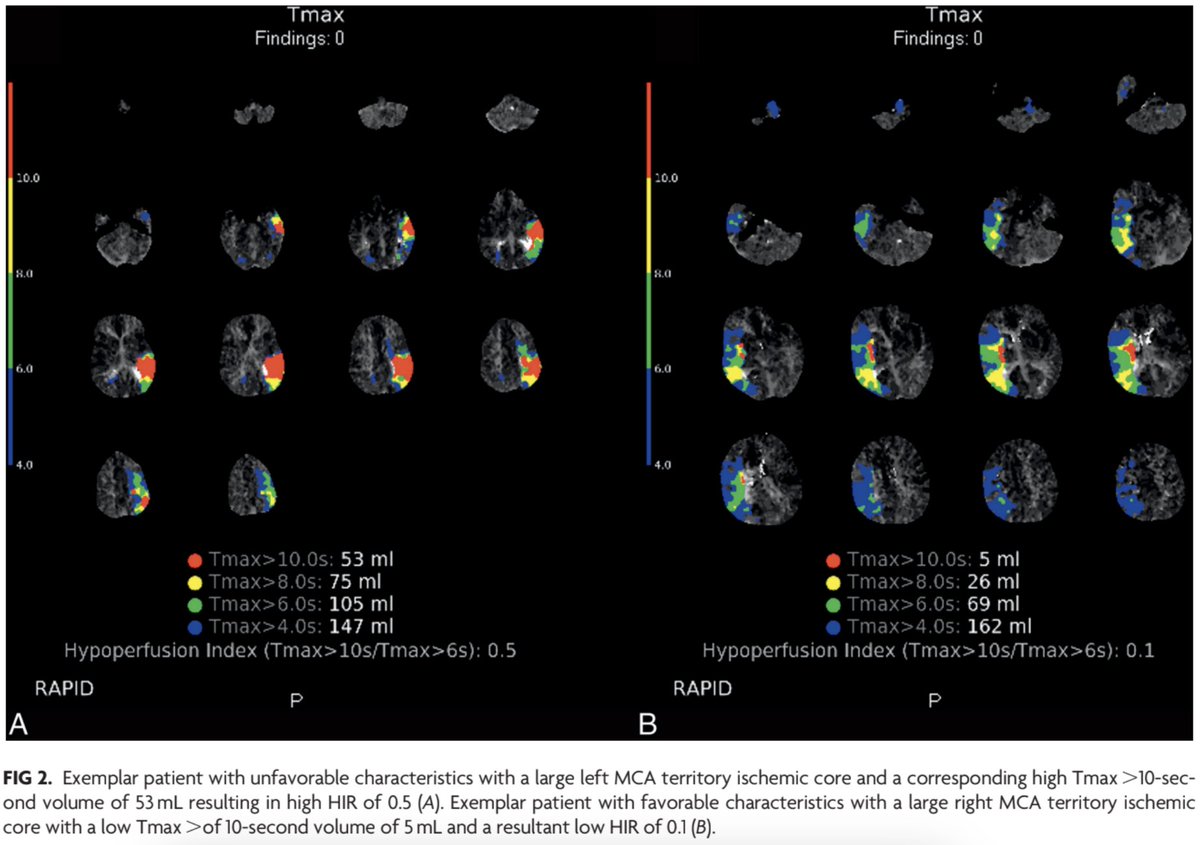 dhairyalakhani's tweet photo. In LVO stroke with unsuccessful endovascular thrombectomy, low hypoperfusion intensity ratio (HIR <0.4) predicted good 90-day functional outcomes, reflecting robust tissue-level collateral status.

By @vsyedavalli

https://t.co/DxnfvuEIUk https://t.co/1xRLfjV3My