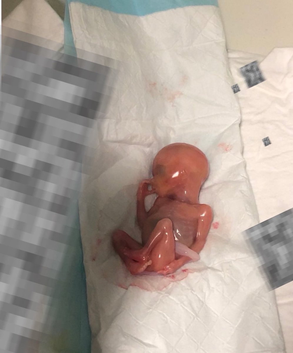 Meet baby Samuel. He was born alive after a failed abortion at 16 weeks old, sucking his thumb.

He reportedly lived for 30 minutes.

This is the reality of abortion.

It’s not “healthcare” or “empowerment,” it’s murder.