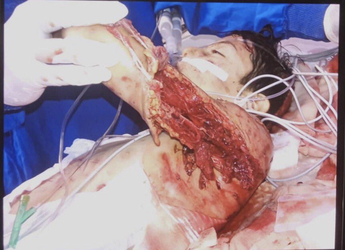 <a href="/emrekarayel01/">emre karayel</a> Şuraya başıboş köpeklerin çocuklara neler yaptığına dair de bir örnek bırakayım…

Bu Tunahan; 9 yaşında okula giderken 20 başıboş köpek tarafından parçalandı. Bu sadece parçaladıkları bir kolu. Kasım bölgesi iki bacak içi, iki kolu, kafası bedeni, her yeri parçalandı ve bu