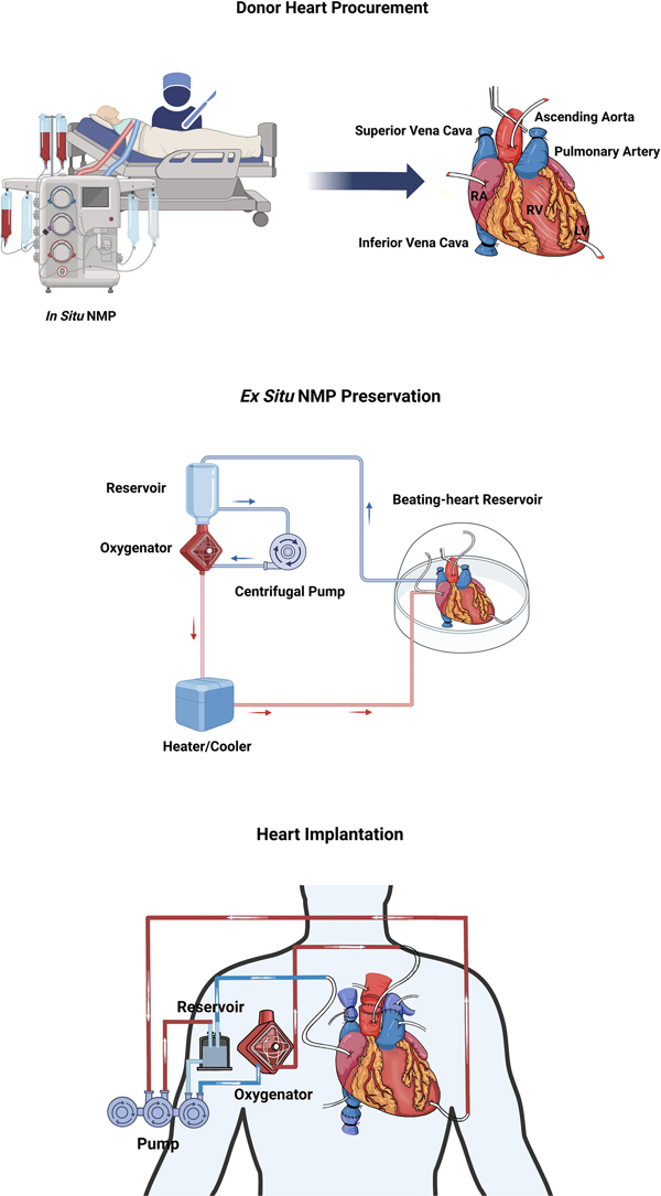 JACCJournals's tweet image. Ischemia-free beating #HeartTx is feasible and could redefine graft preservation in cardiac transplantation, enabling longer-distance transport and expanding the donor pool. jacc.org/doi/10.1016/j.… #JACCCaseReports
