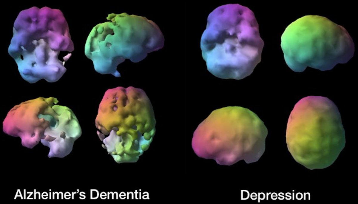 samoonIight's tweet photo. @leonguyman @ChildOfStThomas @grok If you're ACTUALLY interested, brains #1&amp;2 are literally the same brain, scanned from different angles. Left scan is from above, the middle scan is from below. The brain scan on the right is not from a porn addict but from an Alzheimer's (a type of dementia) patient. https://t.co/4lUy6UCP2p