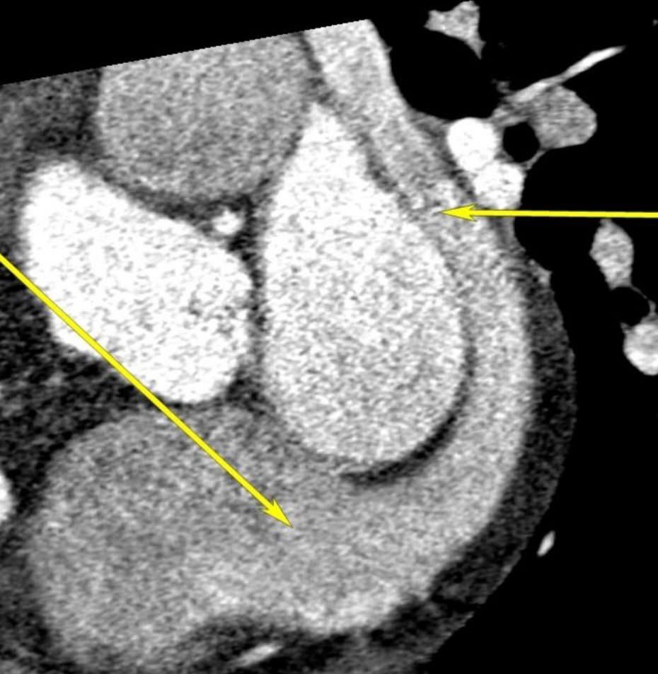 EACVIPresident's tweet photo. 🫀📸 EACVI Imaging Challenge – Case 3

🔍 When details make all the difference

🏥 Submitted by: Bassam Hasan
📍 University of Baghdad – College of Medicine
🤝 Co-author: Mahmoud Ismail

👩‍⚕️ Clinical scenario
Adult female presenting with palpitations and exertional dyspnoea, referred for advanced imaging assessment.

❓ Which adult congenital heart disease is demonstrated in the images?
1️⃣ Coronary artery fistula
2️⃣ Partial anomalous pulmonary venous return
3️⃣ Persistent left superior vena cava
4️⃣ Unroofed coronary sinus

@rafavidalperez @YBououdina @MSBBrandao @ydaryani @Elizabeth_antos @pfelissamburu @CharlesFauvel @alexsfelixecho @galzeranod @andgiannopmd @hrt01a @WilliamKokFaiK1 @M_Marwan_ @drahmedmohsen85 @aniela_petrescu @benayozbay @slumberbell @senguptasp @ElizabetaK10533 @samsrivastava77 @MihaiTrofenciuc @C_VanDeHeyning @drozgeozden @Giulia_Vinco @VazyurVasquez

1/2