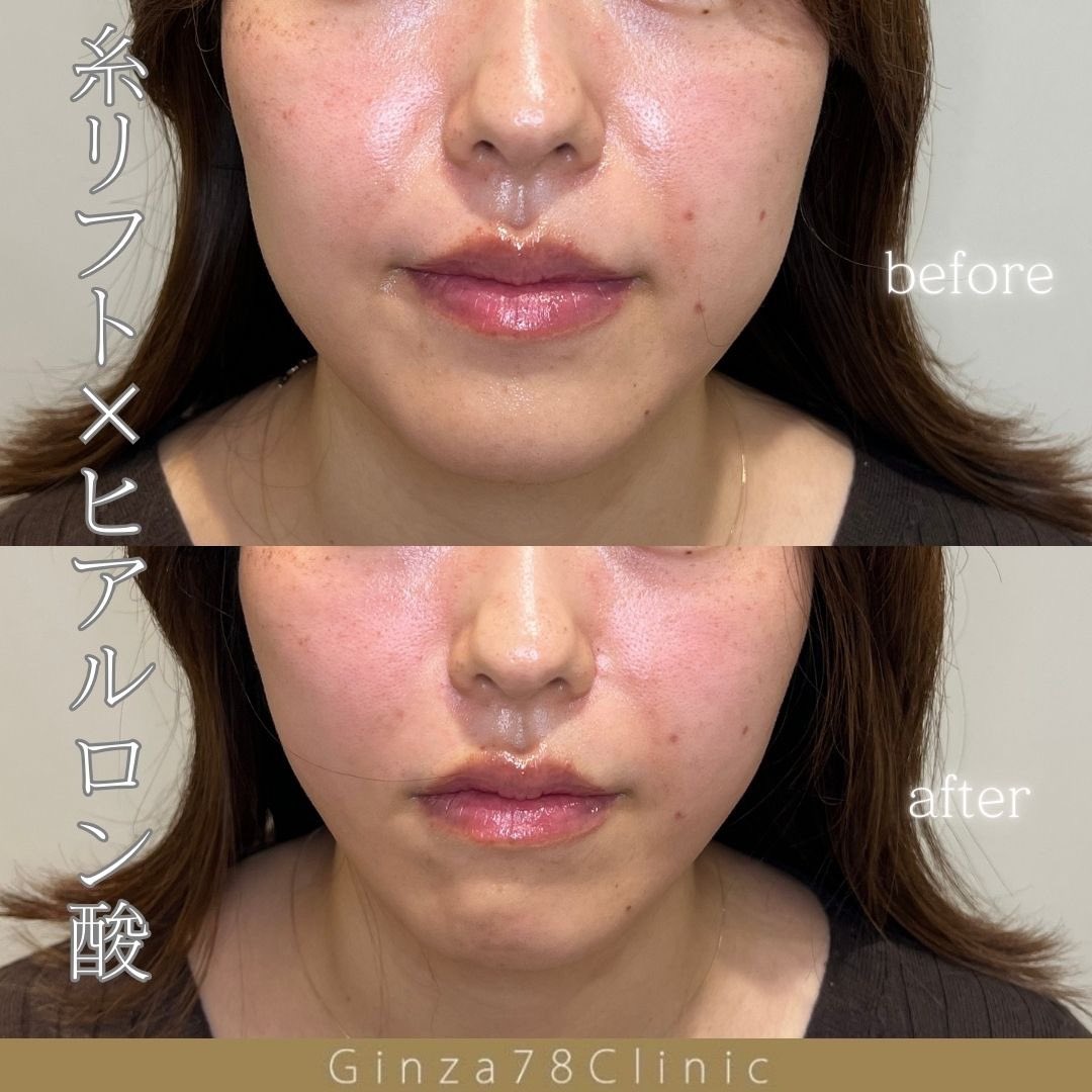 執刀医】田中医師 【内容/価格】 PDO6本/1本¥16,000 G-lift flex2本/1