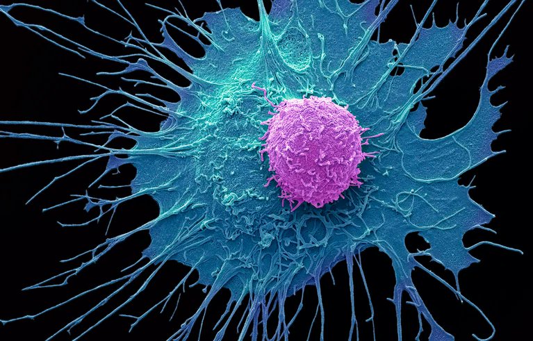 manuelacasasoli's tweet photo. Read about an innovative CAR-T therapy that destroys #Cancer cells without dangerous side effects.
"A new generation of engineered immune cell destroys cancer cells in mice as effectively as conventional CAR-T-cell therapies without suppressing the immune system, a serious side effect. The engineered cells could also be used to treat some people with autoimmune conditions, such as lupus."
#Science #Biology #Medicine #Immunology
⏯️ https://t.co/q4Ma3WTIWH
⏯️ https://t.co/OkuzK6jtZC