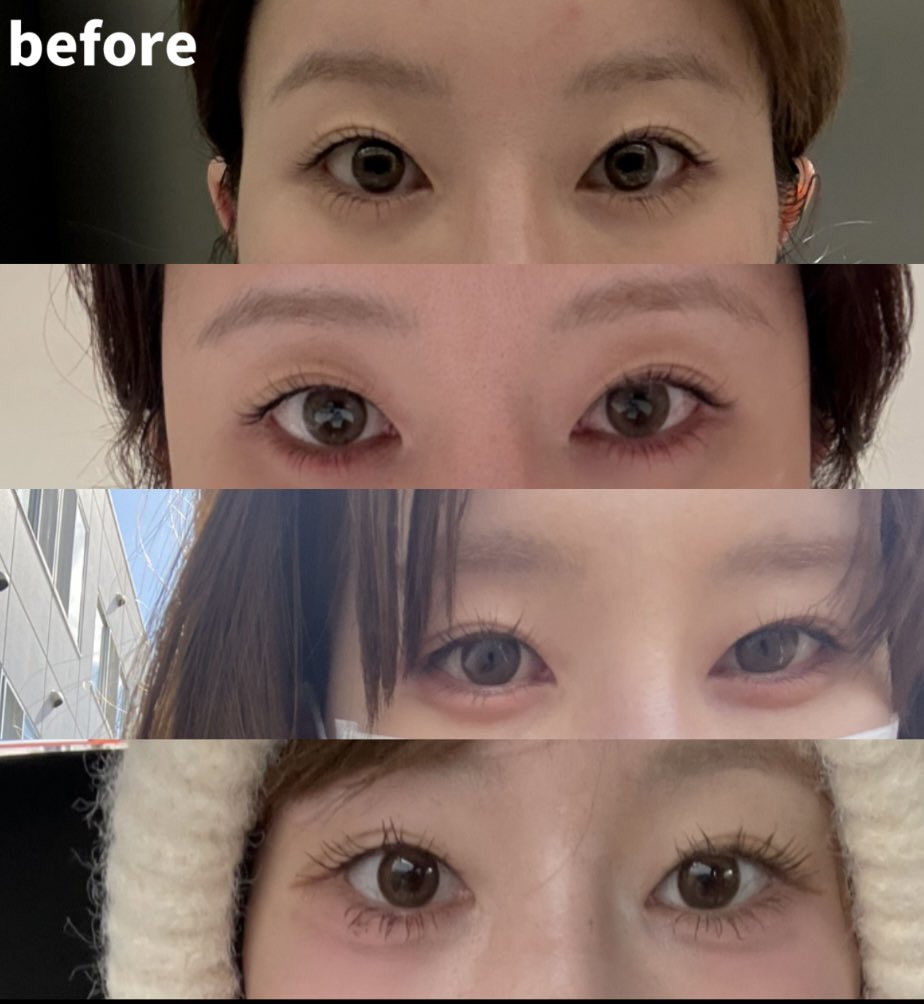 yMRRGutEGy43621's tweet photo. オンユ美容整形外科で自然癒着をしてから3ヶ月が経過しました！！
2ヶ月すぎたあたりからすごくナチュラルになってきて今ではもう理想すぎる二重になりました🧡🧡
術前と見比べるとすごく可愛くてナチュラルな目元になれたと思います🧡🧡
本当に大満足です🧡🧡
ありがとうございました☺️☺️ https://t.co/d0hkgX3jZQ