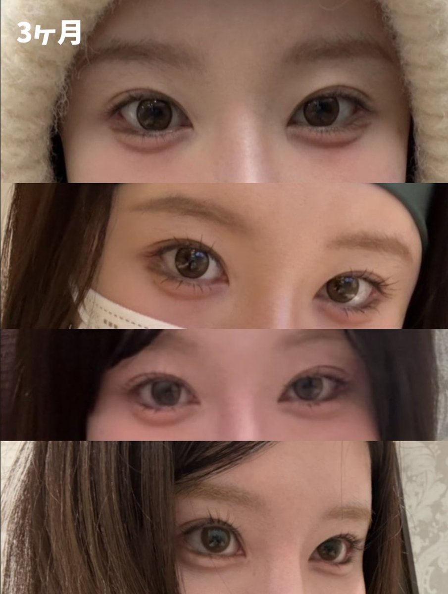 yMRRGutEGy43621's tweet photo. オンユ美容整形外科で自然癒着をしてから3ヶ月が経過しました！！
2ヶ月すぎたあたりからすごくナチュラルになってきて今ではもう理想すぎる二重になりました🧡🧡
術前と見比べるとすごく可愛くてナチュラルな目元になれたと思います🧡🧡
本当に大満足です🧡🧡
ありがとうございました☺️☺️ https://t.co/d0hkgX3jZQ