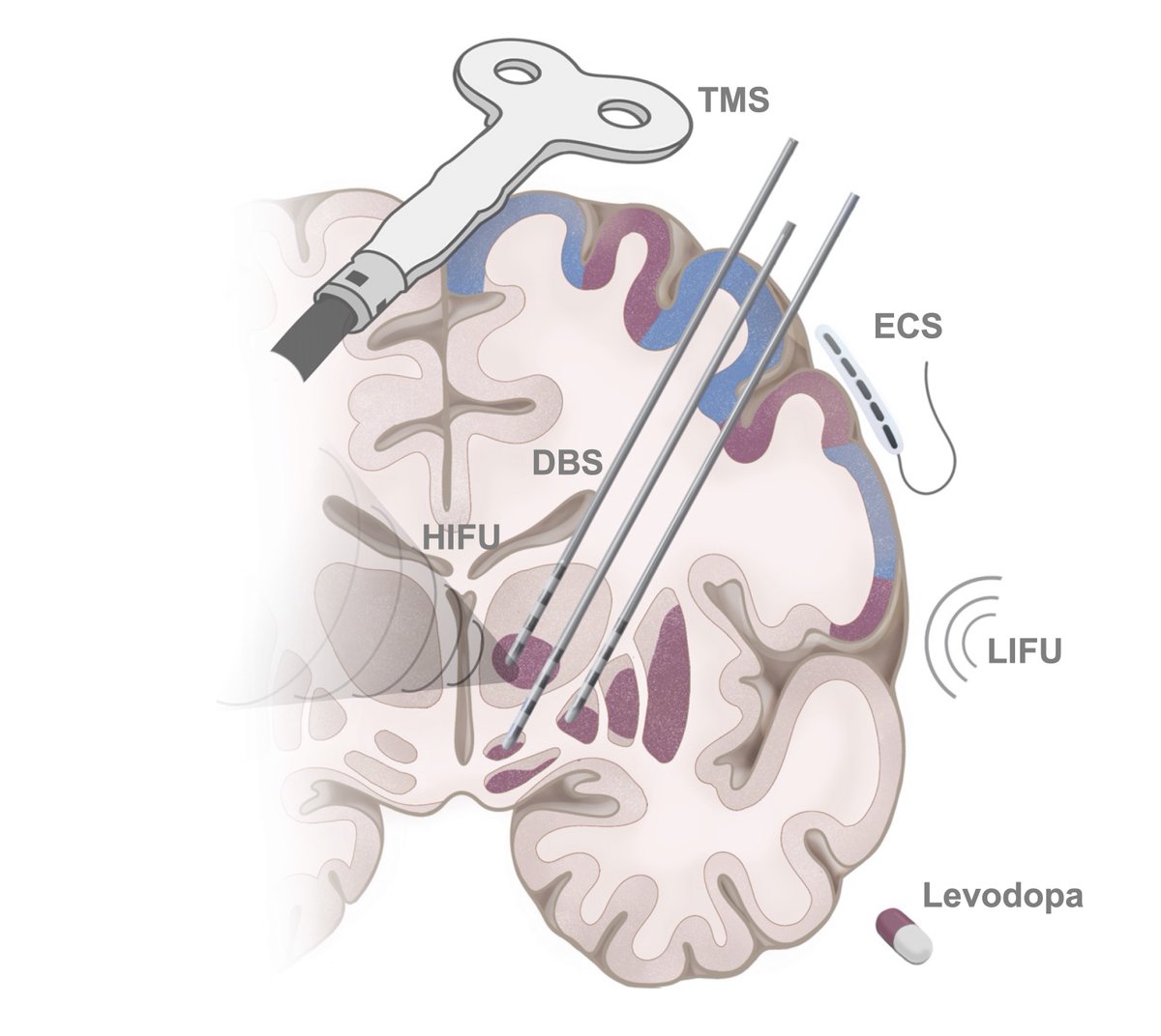 Scientific American has a great coverage of our Nature paper on Parkinson's circuit dysfunction. 
scientificamerican.com/article/extrao…

nature.com/articles/s4158…
<a href="/ndosenbach/">Nico Dosenbach</a> <a href="/foxmdphd/">Michael Fox</a>