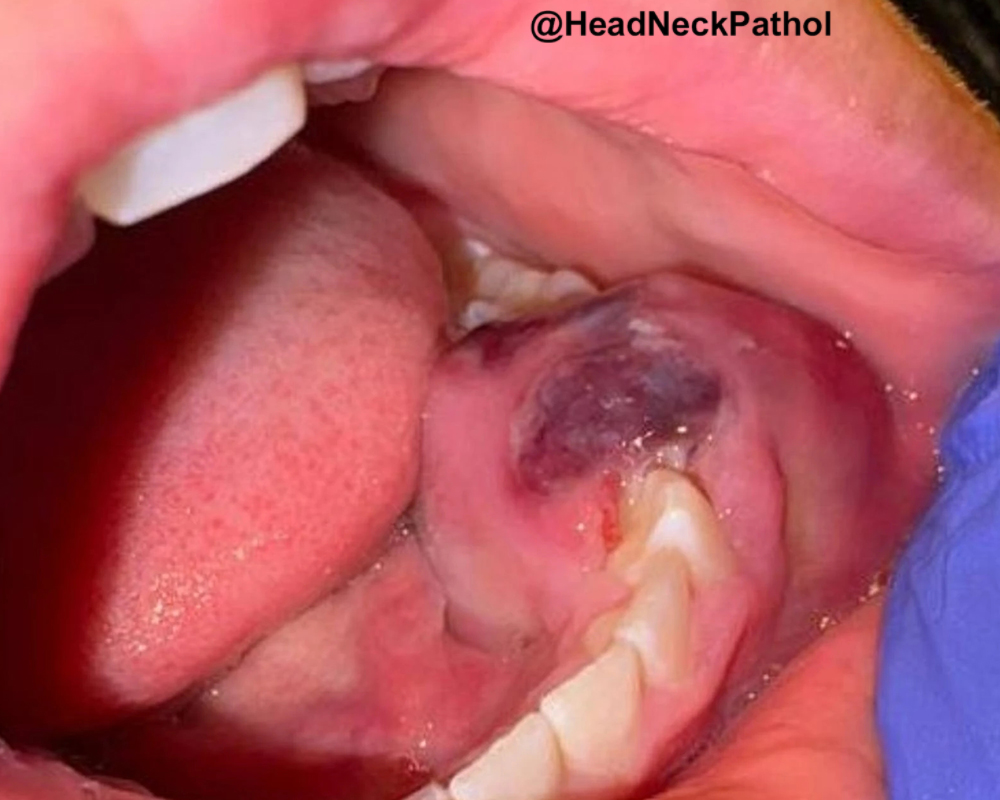 Head Neck Pathol tweet media