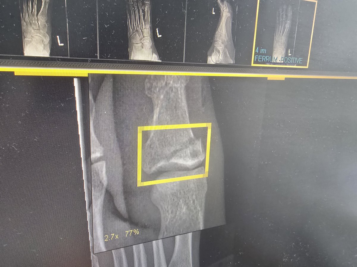 zipinsight's tweet image. 그냥 아프다고 생각했는데 노숙자가던진 의자에 맞은 곳이 부러졌네요 ㅎㅎ

어쩐지 아프더라 ㅎ

또 만나면 친하게 반겨주고 싶네요 ^^

하필 손님들이 그 친구를 놔두고 저를 두손으로 잡고 막아주셔서 ㅎ