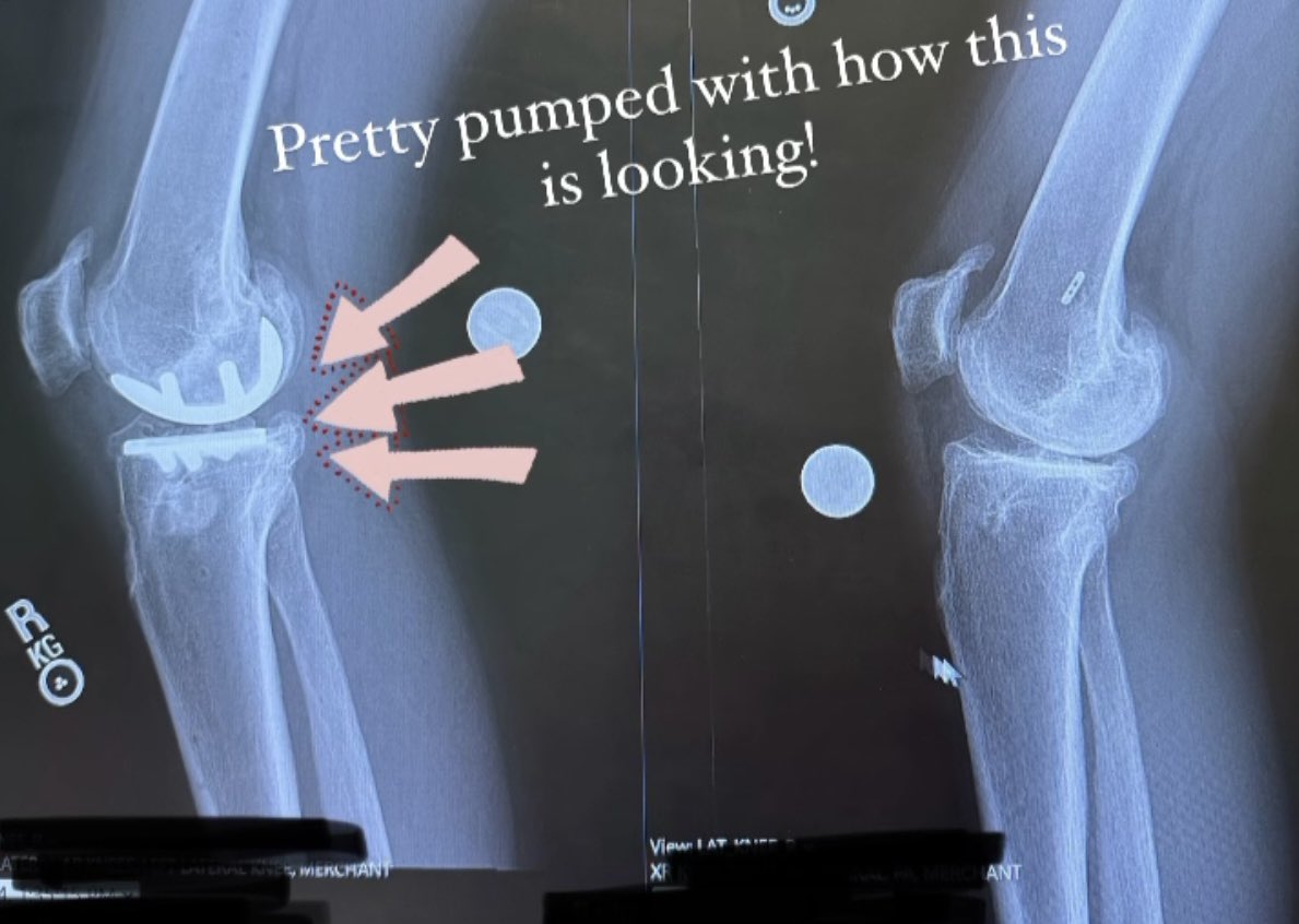 luisriosreb's tweet photo. @Brett_A_Taylor Ortho...she has severe bilateral  DJD. Had a Mako Uni done in the right, needed a TKR but wanted to compete. She will need a conversion in the future. The Lt  has an ACL done, arthrosis, so its a re tear not much instability as it is already deformed. Go for it 🥇 https://t.co/CNVCUSuXPE