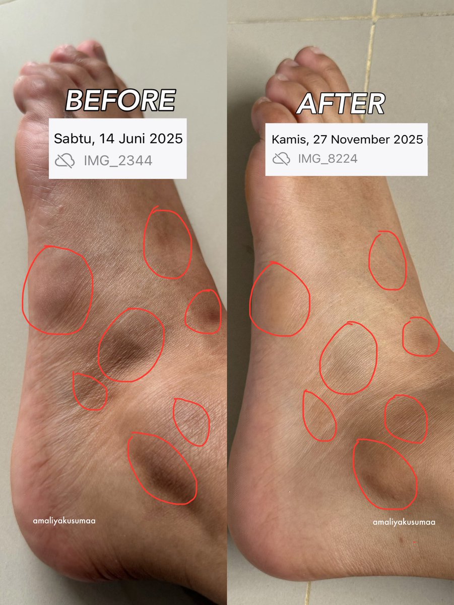 amaliyakusumaa's tweet photo. BIG THANKS TO THEM.... in this economy, no more clinic treatments needed for this result. lipatan hitam gone, and truly worth every penny👌🏻💯 https://t.co/RENqwSTf6a