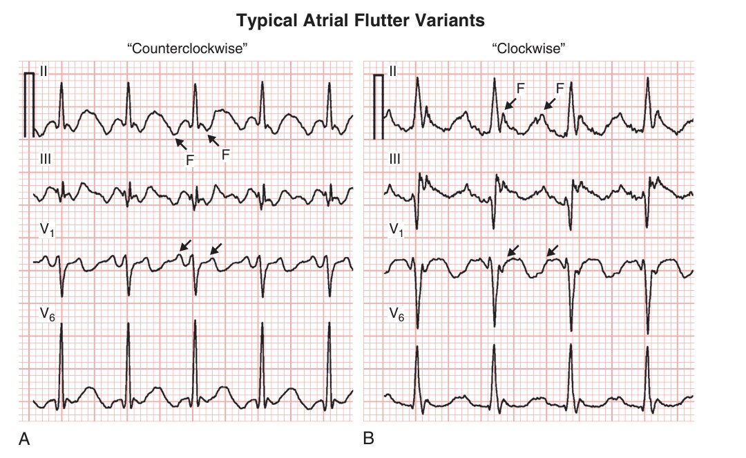 Typical Atrial Flutter on ECG: Understanding Clockwise vs Counterclockwise Circuits

Atrial flutter is a macro–reentrant arrhythmia involving a large circuit, usually in the right atrium. It’s often described as a “merry-go-round” rhythm with a cycle length of ~200 ms,
