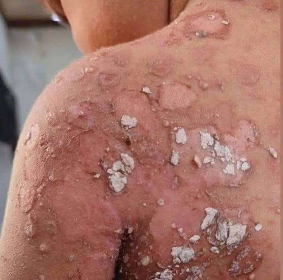 fayyadnidal3's tweet photo. The spread of scabies on my brother's body is increasing — a simple examination that may protect my child from pain 😭

Please! We need treatment urgently before it's too late.
If you’re scrolling, PLEASE leave a dot . it's just a dot
https://t.co/TW4JPiykIA https://t.co/oZV4MIcV8f