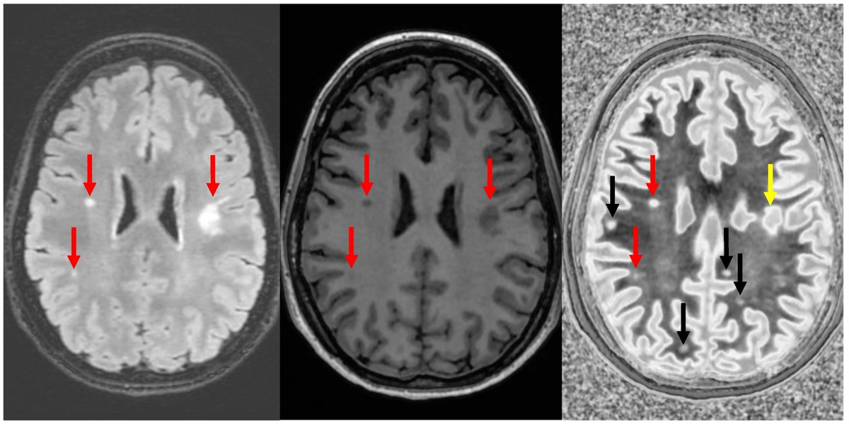 Bioeng_MDPI's tweet image. 💥Highly recommended publication: "Ultra-High Contrast MRI: Using Divided Subtracted Inversion Recovery (dSIR) and Divided Echo Subtraction (dES) Sequences to Study the Brain and Musculoskeletal System"
🔗shorturl.at/uMfif
🏫@TeWhatuOra
📌#MRIContrast #braininjury