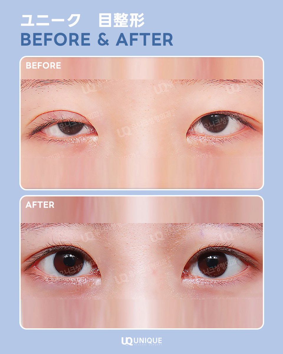 unique__jp's tweet image. #二重整形 失敗した方..🥲

修正は #ユニーク美容外科 で✨

左右差がある場合も二重のラインを下げたい場合も綺麗に修正いたします。

気になった方は、
✉️ line.me/ti/p/ASaI14sy4x 

#二重症例 #整形垢 #二重修正 #ユニーク美容外科