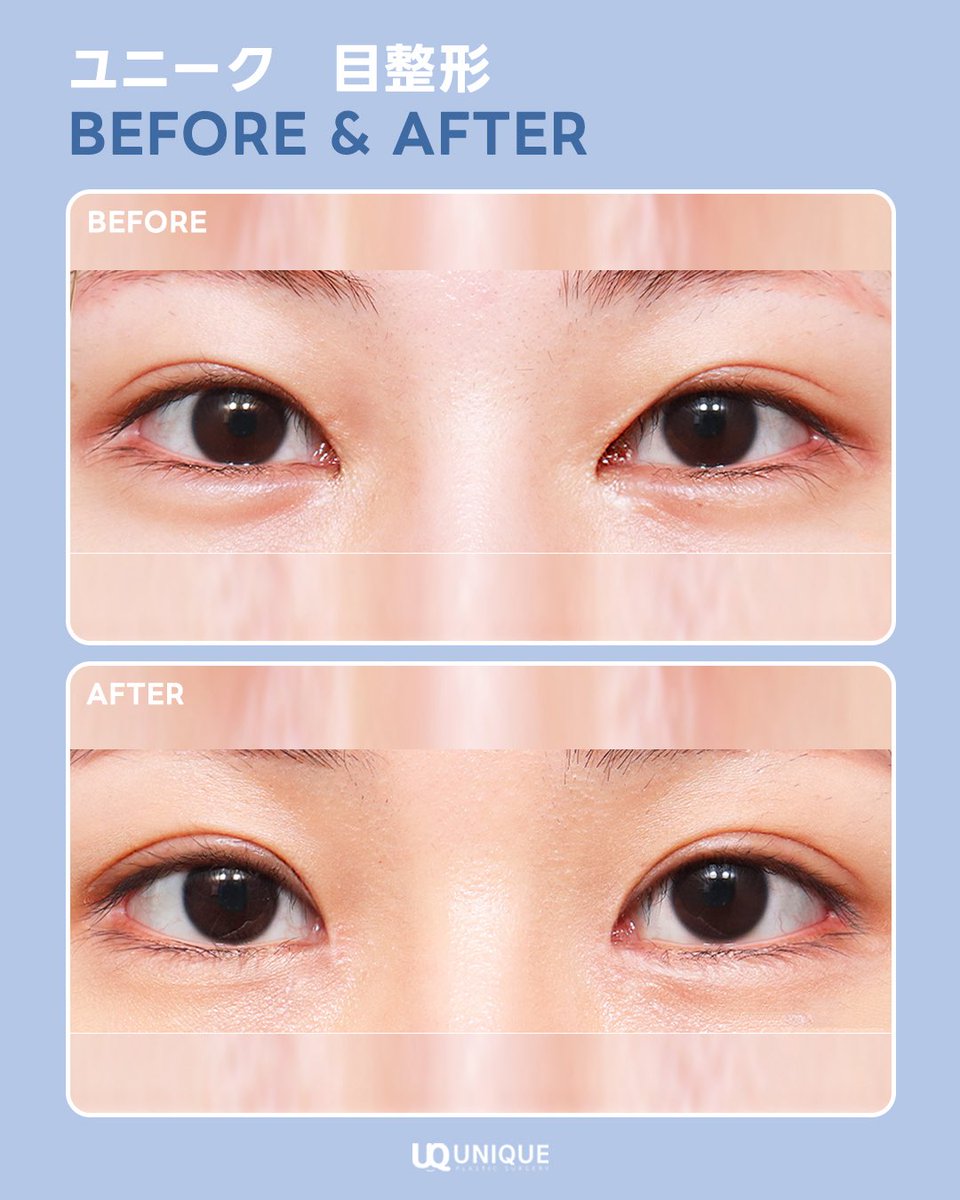 unique__jp's tweet image. 二重のラインが気に入らない❓

一度 #二重整形 をしたけどラインを変えたい方必見💡

当院は #目再手術 が得意な病院です✨

この患者様も目頭の部分を中心に再手術されました🥰

気になった方は、
✉️ line.me/ti/p/ASaI14sy4x 

#二重症例 #整形垢 #二重修正 #ユニーク美容外科