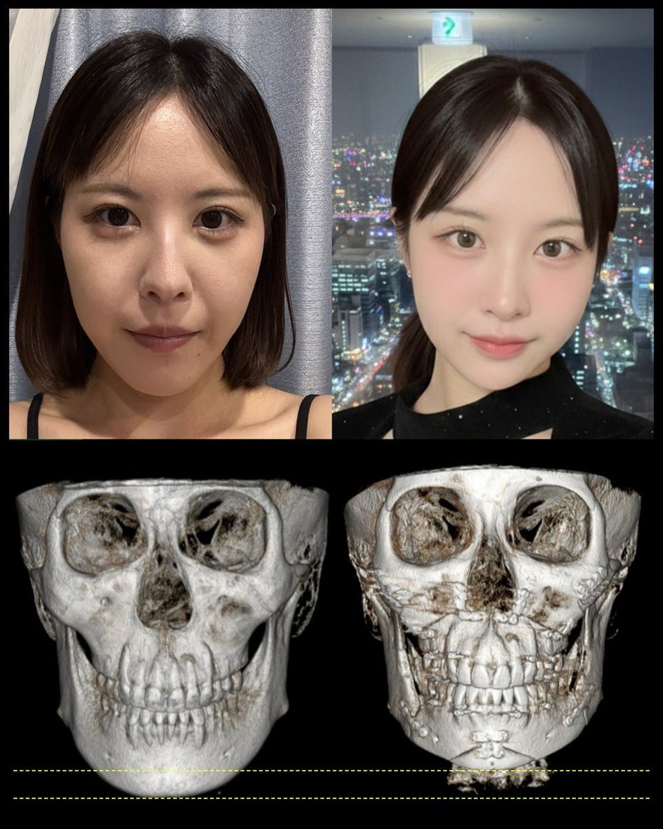 farim_dt's tweet photo. 📷ギリン整形外科 両顎+輪郭3点＋筋肉縛り 6ヶ月経過

骨切り : ユン・スンギュ先生
脂肪吸引+筋肉縛り : パク・ドクジュン先生
┈┈┈┈┈┈┈┈┈┈
▼手術内容▼
両顎手術、頬骨固定、ニューV、オトガイ前進、オトガイ短縮、二重あご脂肪吸引＋筋肉縛り

#ギリン美容外科 https://t.co/u0xHola80O