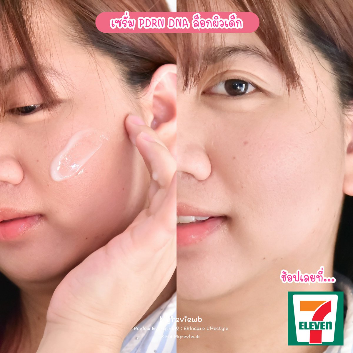 myreviewb's tweet photo. วร้ายย !! เซรั่ม PDRN ล็อกผิวเด็ก เซรั่มสูตรใหม่ของ #InnBeautyTH ส่วนผสมปังมาก มี PDRN 0.3% ที่สกัดจาก DNA ปลาแซลมอน มาในรูปแบบซอง ช่วยซ่อม ฟื้นฟูผิวให้แข็งแรงในระดับเซลล์ ฟื้นผิวให้อิ่มฟู แล้วก็มีBakuchiol ช่วยลดริ้วรอย วัยทำงานแบบเราๆ ผิวล้า เหนื่อยคือควรเลยละ https://t.co/nqxfY1U9lJ