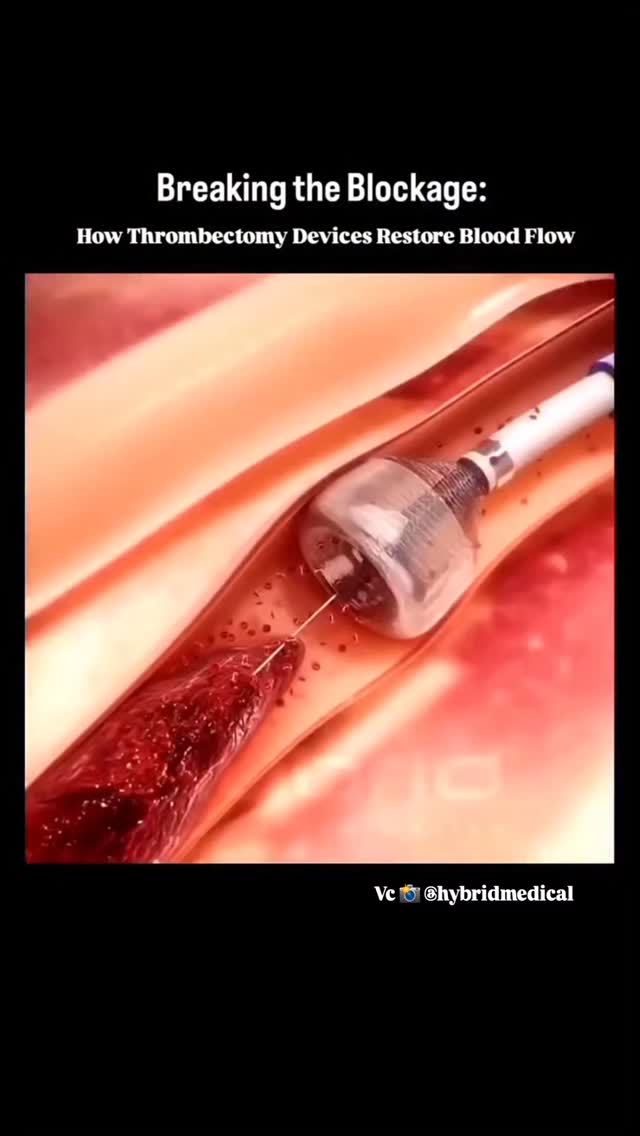 NAH_uitleg's tweet photo. Een trombectomie is een snelle behandeling om een stolsel uit een bloedvat in de hersenen te verwijderen bij een herseninfarct. Helaas is dat niet geschikt voor iedereen en wordt alleen toegepast in specialistische ziekenhuizen.
https://t.co/vgw1jtwfwO

https://t.co/eAgmF4lUN2 https://t.co/H9S8s0dzh1