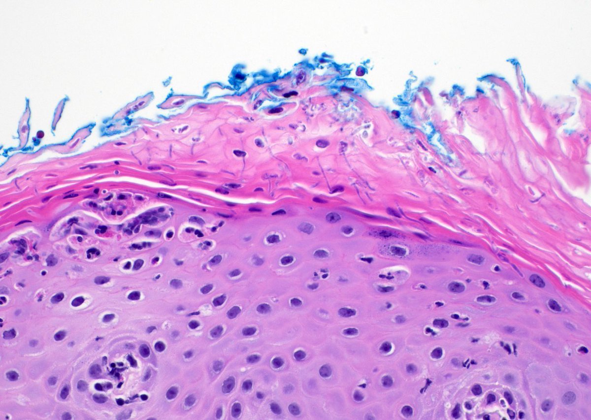 JMGardnerMD's tweet photo. Vulvar skin biopsy. Erythematous pruritic eruption. Your diagnosis? 
Answer ✅ https://t.co/aMtuEBa9p6
Only H&amp;E stain needed for this one! 
#pathology #pathologists #pathTwitter #dermpath #dermatology #dermatologia #dermtwitter #gynpath #obgyntwitter https://t.co/ThowkuUclt