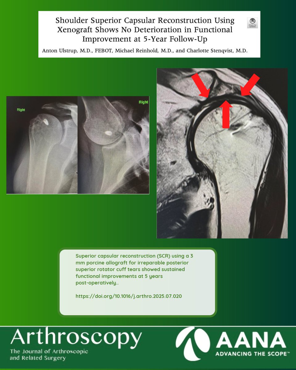ArthroscopyJ's tweet image. Superior capsular reconstruction with a 3 mm porcine xenograft delivers sustained functional improvements and impressively low re-tear rates—even 5 years after surgery. Read the full study: doi.org/10.1016/j.arth… #Arthroscopy #ShoulderSurgery #RotatorCuff #Orthopedics