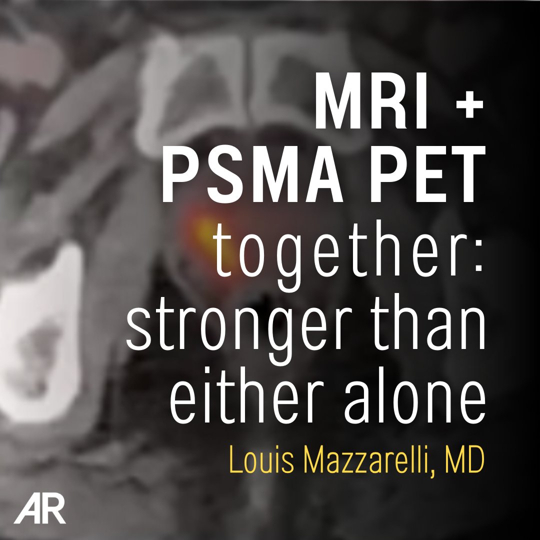 Applied_Rad's tweet photo. Staging matters.

In part 2 of his video case study series, Louis Mazzarelli, MD shows how PSMA PET imaging adds clarity to prostate cancer management decisions.

▶️ Watch Part 2 of the PSMA PET Video Case Study Series: https://t.co/tphFayPRSa

#PSMAPET #Radiology #CaseSeries #ProstateCancer #MolecularImaging #PETCT #RadEd #MedEd