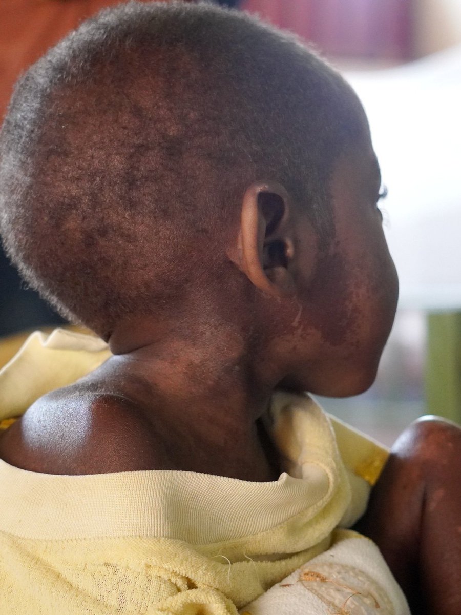 savingmoses's tweet image. When a baby is severely malnourished, it is common for their skin to begin peeling and their hair to become brittle. The reality of malnutrition can be hard to talk about, but the reality of what will happen if we don't is even more difficult. Join us at savingmoses.org.