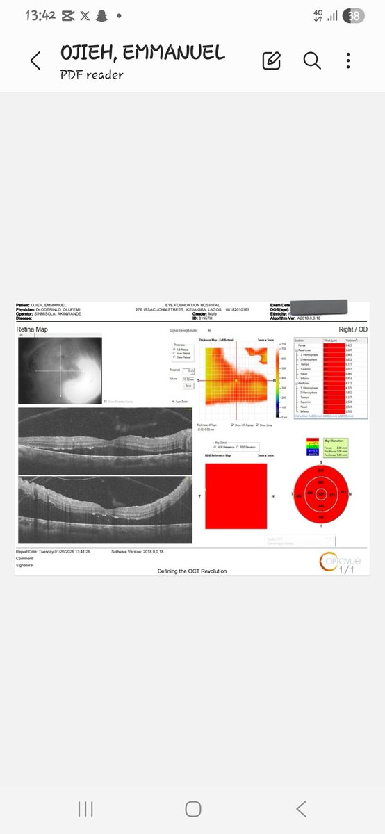 dexxtero's tweet image. A CRY FOR HELP!!

I was diagnosed of SICKLE CELL RETINOPATHY in February 2025. I had to undergo laser photocoagulation on both of my eyes. 

Unfortunately i lost one of the eye to retina detachment.

December last year, My retina got detached in the remaining eye and it's been a…