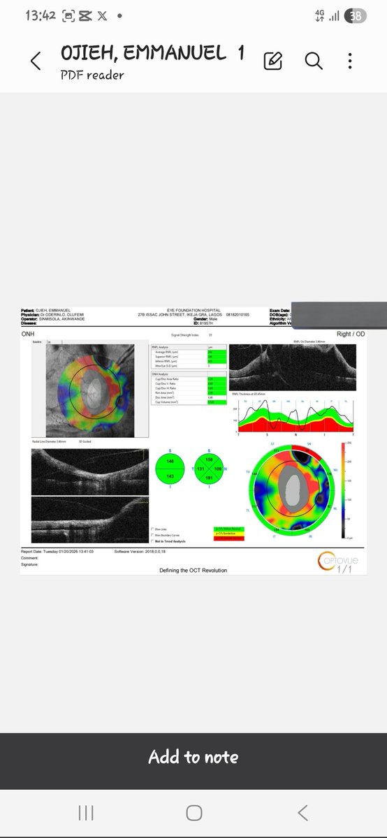 dexxtero's tweet image. A CRY FOR HELP!!

I was diagnosed of SICKLE CELL RETINOPATHY in February 2025. I had to undergo laser photocoagulation on both of my eyes. 

Unfortunately i lost one of the eye to retina detachment.

December last year, My retina got detached in the remaining eye and it's been a…