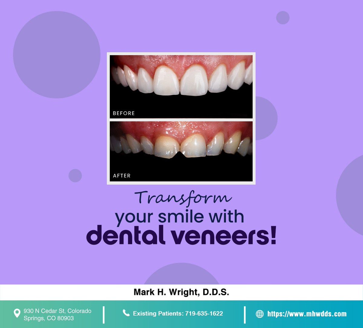 Restore your smile with the help of dental veneers. Schedule a consultation at mhwdds.com to learn how this treatment can transform your smile. #dentalveneers #smiletransformation #smilewithconfidence #markhwrightdds #coloradosprings #CO