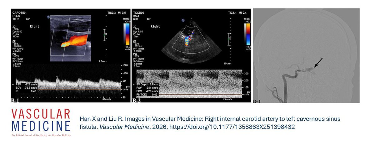 VMJ_SVM's tweet image. Online first: 
Han and Liu present an interesting case of a patient with a right internal carotid artery to left cavernous sinus fistula. 

#carotid #fistula

🔗 doi.org/10.1177/135886…