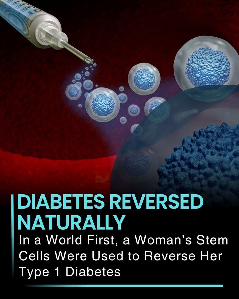 In a world-first medical breakthrough, scientists have successfully used a woman’s own stem cells to reverse her Type 1 diabetes, offering hope for millions living with this chronic condition. The treatment regenerates insulin-producing cells in the pancreas, restoring the body’s