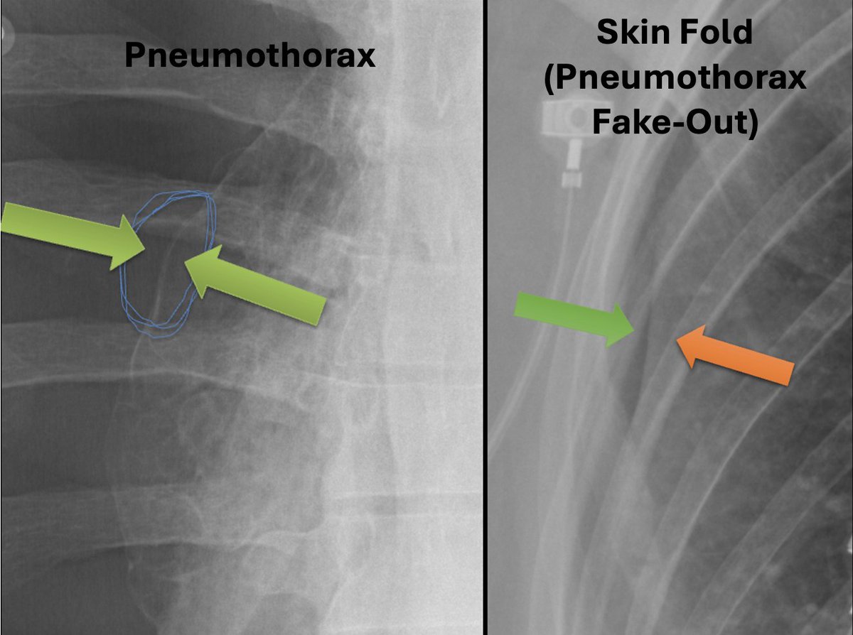 MaddiWulfeckMD's tweet photo. 🚨 This CXR shows a large pneumothorax with possible mild tension🫁💥

One of the most dangerous “simple” diagnoses in imaging—because missing it changes everything.

🧠 How to never miss a pneumothorax again:
➡️Pleura is a pencil-thin white line with air (black) on either side
➡️Lung markings will be absent more peripherally
➡️Invert the image for improved visualization
➡️Helpful if deep sulcus sign is present on supine view

🕵️‍♀️Watch out for the fake-outs like skin folds!

📞☎️Instant, no-hesitation phone call needed!