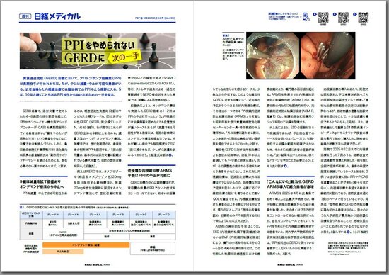 胃食道逆流症（GERD）治療において、プロトンポンプ阻害薬（PPI）は
