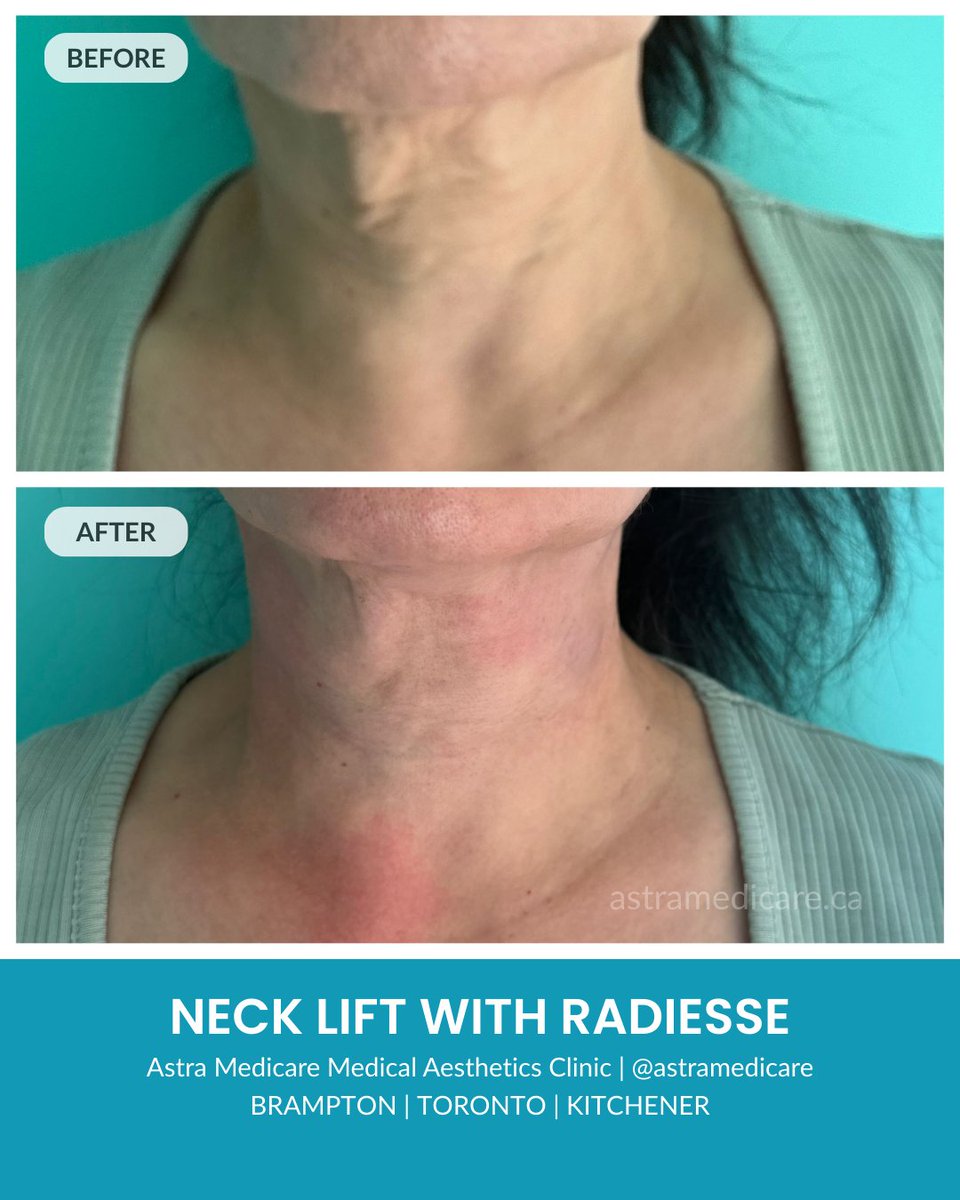 𝑵𝒐𝒕𝒊𝒄𝒊𝒏𝒈 𝒔𝒂𝒈𝒈𝒊𝒏𝒈 𝒐𝒓 𝒄𝒓𝒆𝒑𝒆𝒚 𝒔𝒌𝒊𝒏 𝒐𝒏 𝒚𝒐𝒖𝒓 𝒏𝒆𝒄𝒌? 𝑻𝒉𝒊𝒔 𝒕𝒓𝒂𝒏𝒔𝒇𝒐𝒓𝒎𝒂𝒕𝒊𝒐𝒏 𝒔𝒑𝒆𝒂𝒌𝒔 𝒇𝒐𝒓 𝒊𝒕𝒔𝒆𝒍𝒇 ✨

This before-and-after showcases a non-surgical neck lift using Radiesse, designed to improve firmness, smooth texture, and