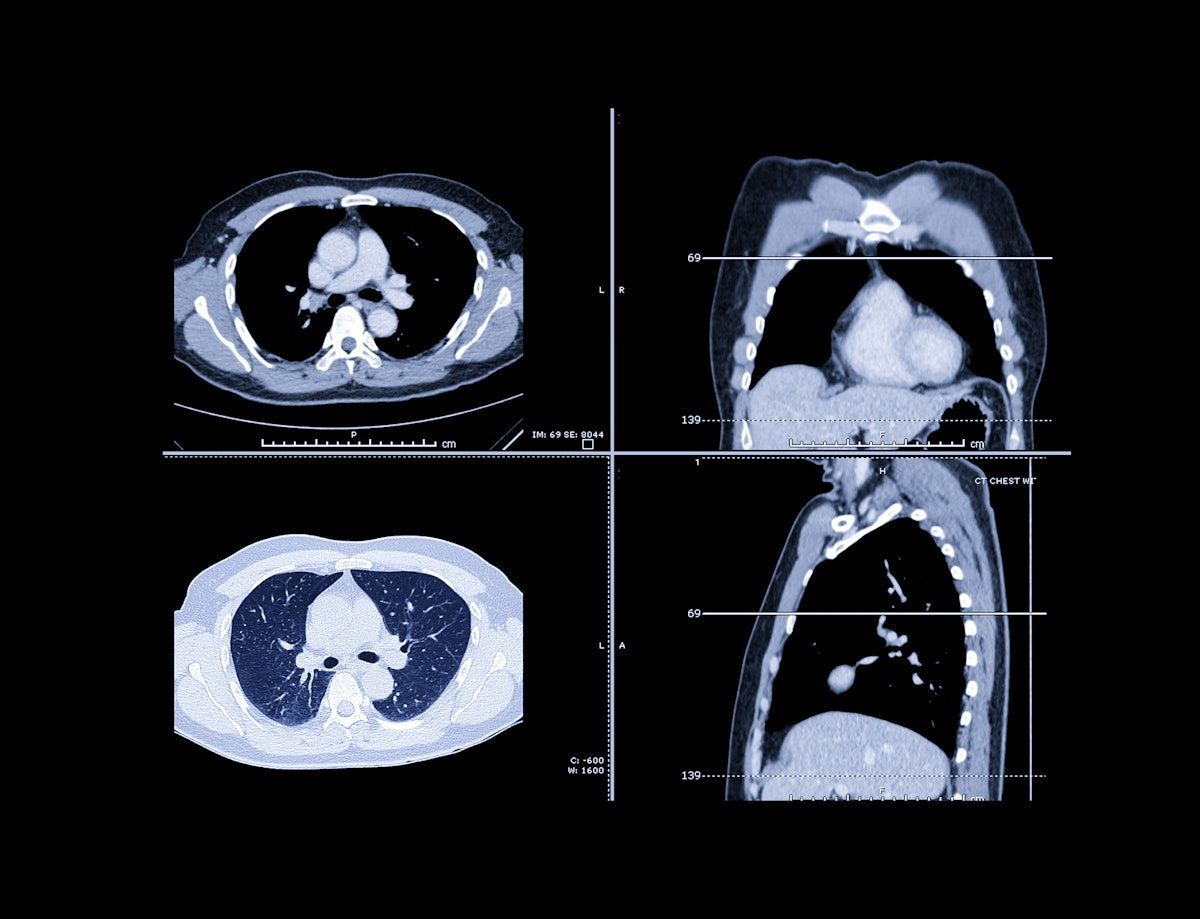 AuntMinnie's tweet photo. Task-specific LLMs more accurate than general ones for identifying ILNs #radiology #AI #lungcancer #ILNs @UF https://t.co/n4mnyXNnI0 https://t.co/ZJFI6hTh5O