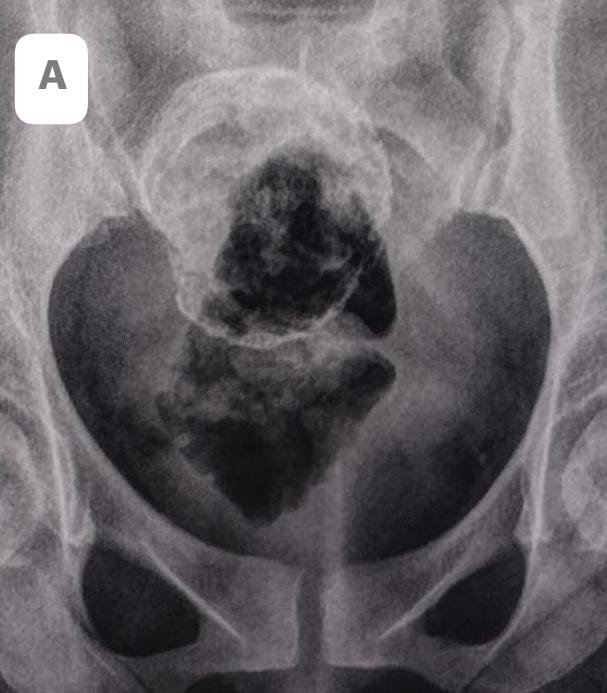 RadMakuo's tweet photo. Comment of the mass
LearnHSGwithme
#Rafiography #Radiology #HSG #Hysterosalpingography
@BrunoNatuhwera @ChroRadGirlie @Rad_Munagi https://t.co/KWjYiac9ht
