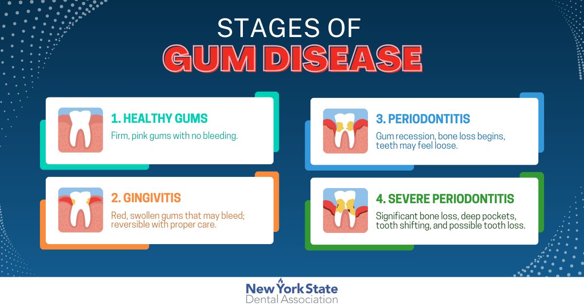 February is Gum Disease Awareness Month🦷 Gum disease doesn’t happen overnight—it progresses in stages and can lead to serious issues if left untreated. Early detection is key! Don’t ignore the signs. Learn more here: mouthhealthy.org/all-topics-a-z…