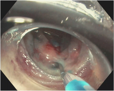 VideoGIE Journal tweet media