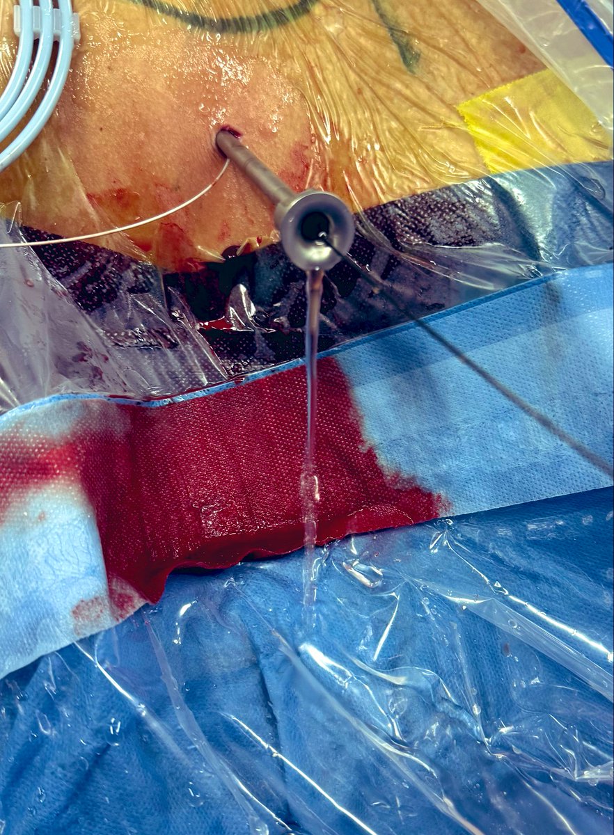 sergiofumero's tweet image. Primera incursión en i-PCNL (by @uroServera) Muy buenas sensaciones. A poco que depuremos la técnica no habrá marcha atrás!! 
#LELR