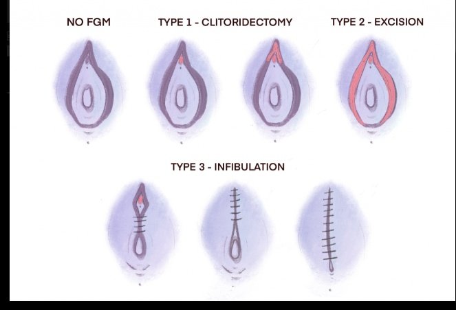 bethabetter's tweet image. Today is World FGM Day; more formally known as the International Day of Zero Tolerance for Female Genital Mutilation.

There are four types of female genitalia mutilation:

-Type I clitoridectomy: removal of the clitoris and/or hood
-Type II excision: removal of clitoris + labia…