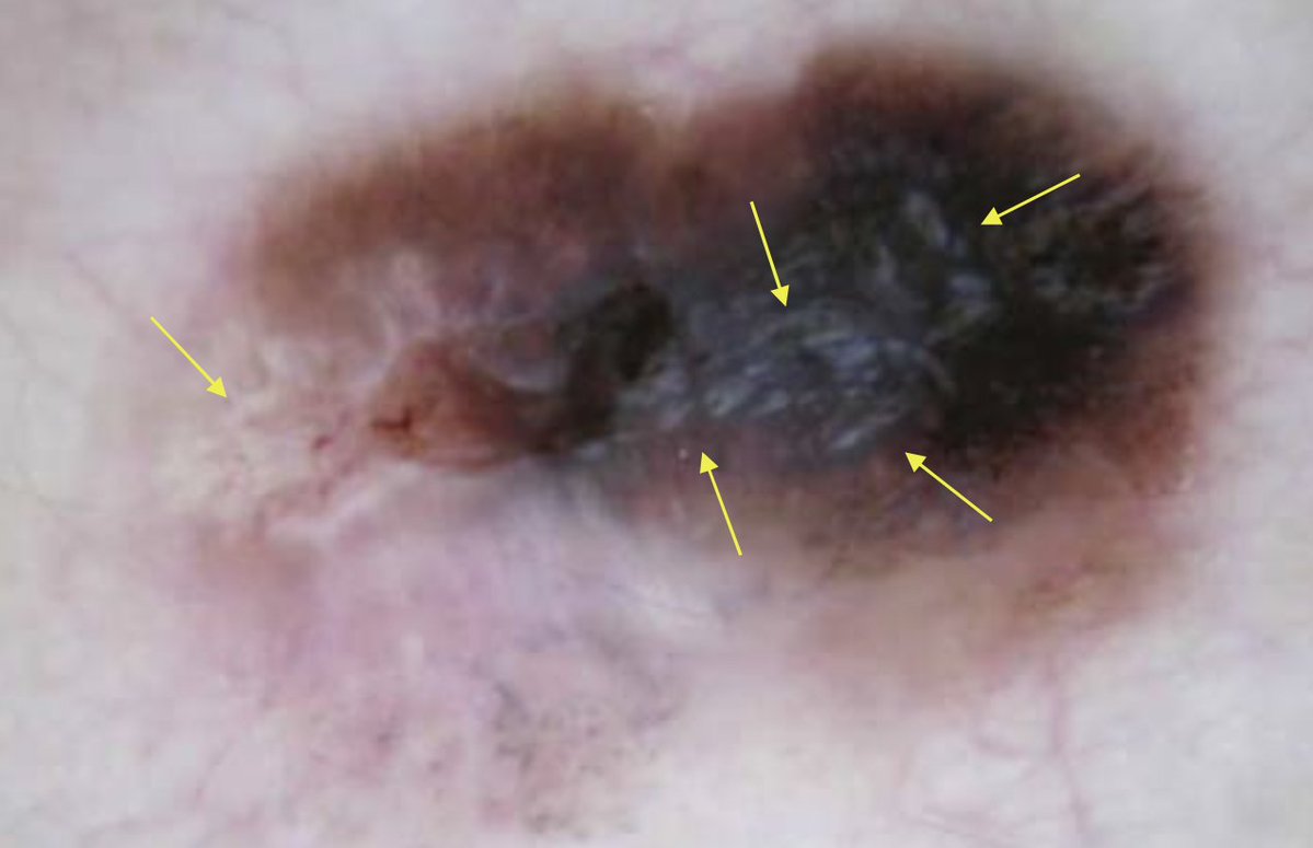 1⃣ Dermoscopic structure a day 

🌟 Shiny white streaks (crystalline structures)
Bright, linear white streaks and/or white blotches

 🔬 Increased  collagen 
Visible ONLY under polarized dermoscopy

#dailyscope
