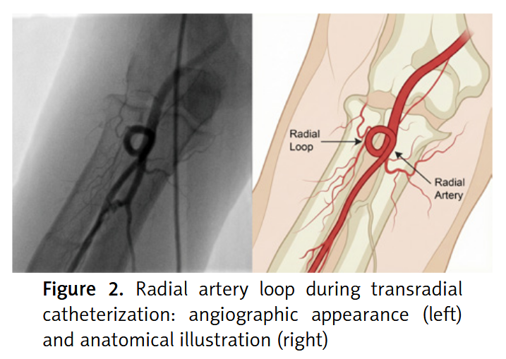 gbiondizoccai's tweet photo. Must-read review on current approaches to radial artery access in interventional cardiology (just disregard the mistaken rate of major vascular complications) https://t.co/EytO40ZObp https://t.co/Iapa73NHc0