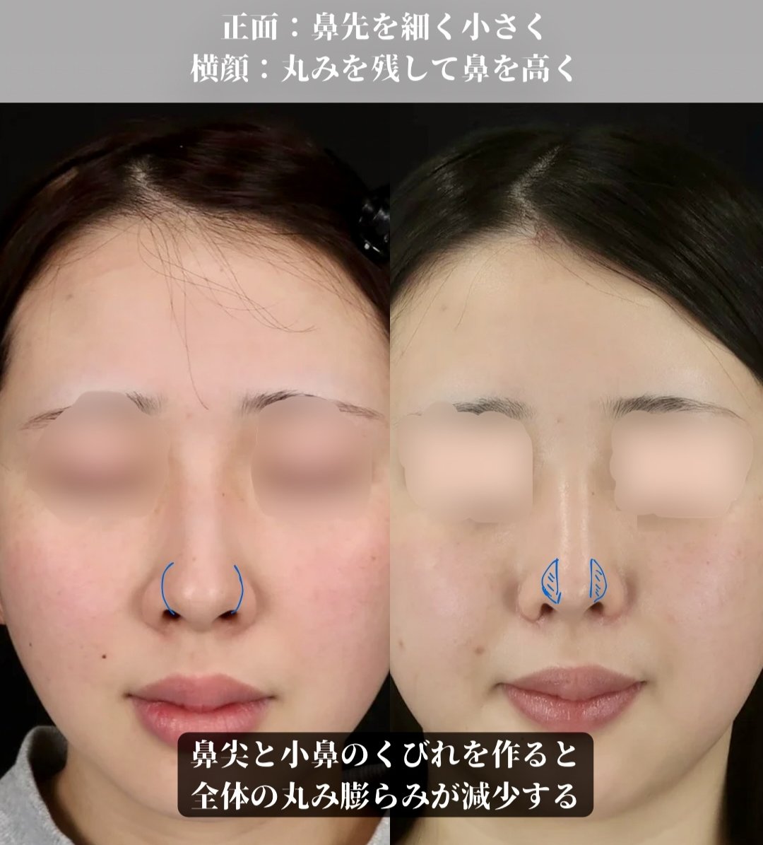 Biyou_no_DR's tweet photo. くびれを作る鼻尖形成
丸みを残すと高くても自然な印象

団子鼻という呼び方のためか鼻先の皮下脂肪が大きく見える原因と思う人もいますが軟骨の形や広がりで小鼻側に膨らんで見える事も多いです

この部分を抑えると丸みが強い人ほど効果を感じやすい様です
逆に横顔では鼻先に丸さを残すと自然です https://t.co/HQGvRnea86