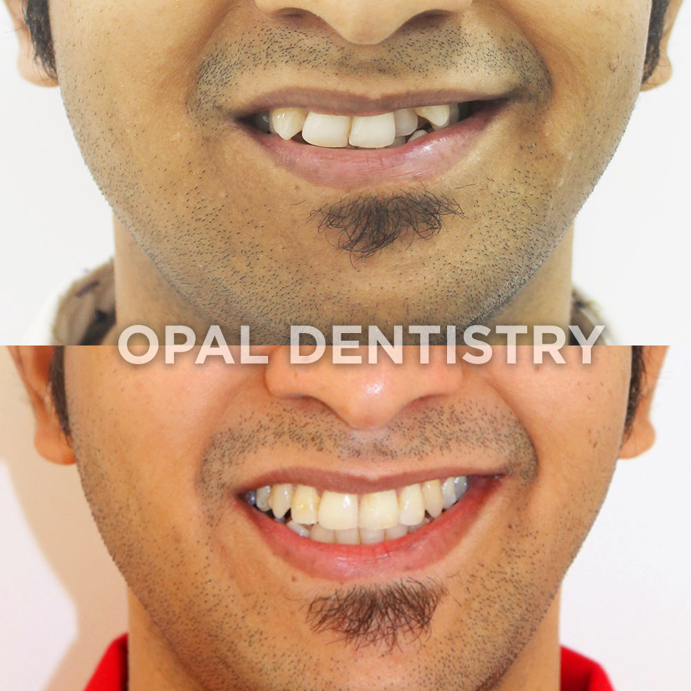 opaldentistry's tweet photo. Severe crowding corrected with Invisalign at Opal Dentistry.
#InvisalignTransformation #SevereCrowding #SmileConfidence #InvisalignIndia #OpalDentistry #SmileMakeover #ClearAligners #ConfidenceStartsWithASmile https://t.co/R87vKKbCYT