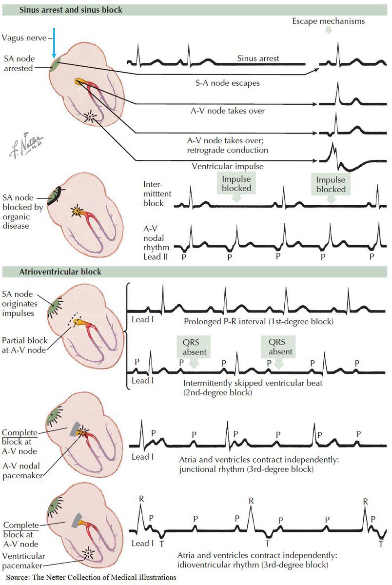 Sinus Arrest, Sinus Block and Atrioventricular Block